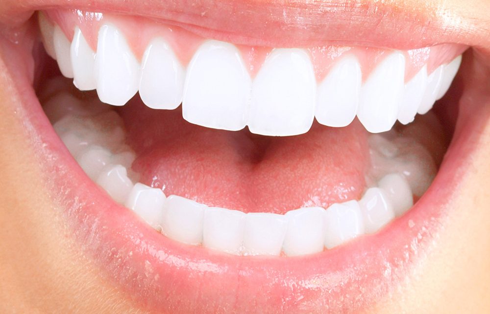 How long do dental laminates last? Beach City Dental