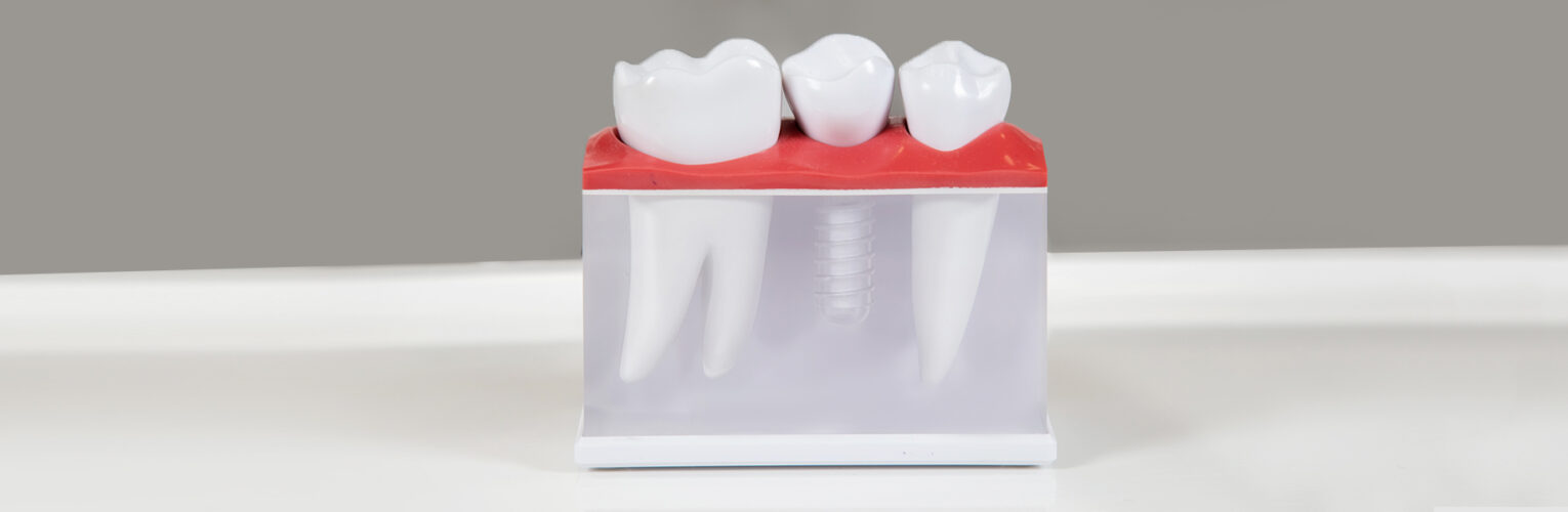 What is the Best and Right Age for You to Get Dental Implants?