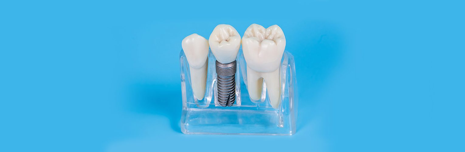 Essential Insights About Dental Implants: What to Know?