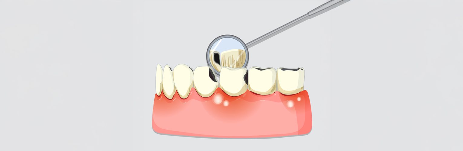 Cavity Treatment Made Easy with Tooth Fillings